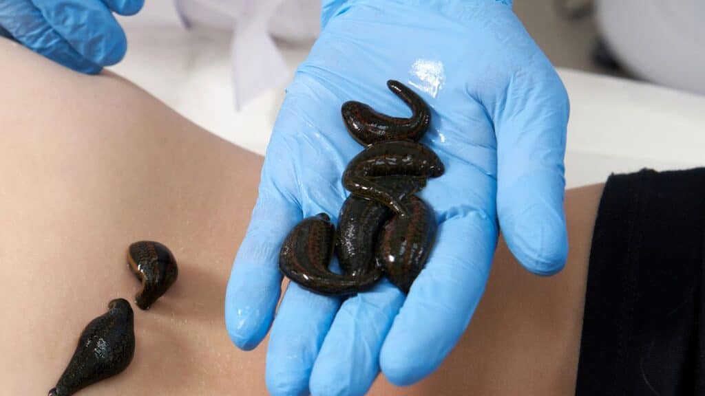 Medical leeches held in a gloved hand with two applied to a person's back, used in traditional bloodletting therapy. Leeching is one of the oldest vintage remedies in historic medicine.