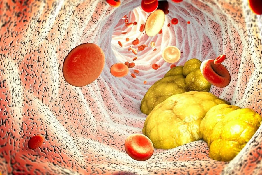 Medical illustration of the inside of an artery with red blood cells flowing past large yellow plaque buildup along the vessel wall. It visually explains how cholesterol can collect in arteries and why people look for ways to lower your cholesterol.