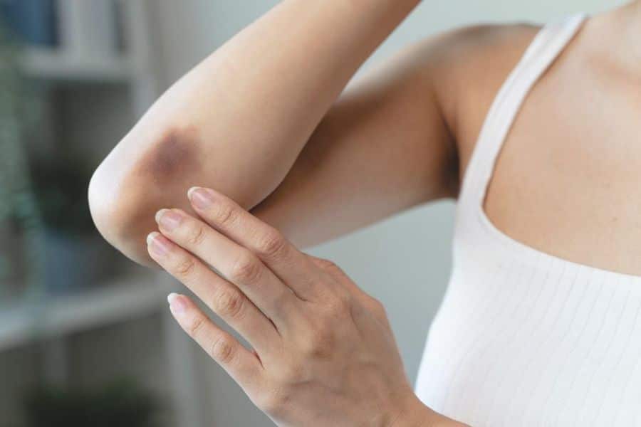 Close up of a person touching a dark purple bruise near the elbow while wearing a white tank top. The photo draws attention to unusual bruising on the skin.