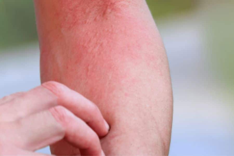 Close up of a reddened irritated patch of skin on a leg while fingers scratch the area. The photo highlights itchy skin and visible inflammation.