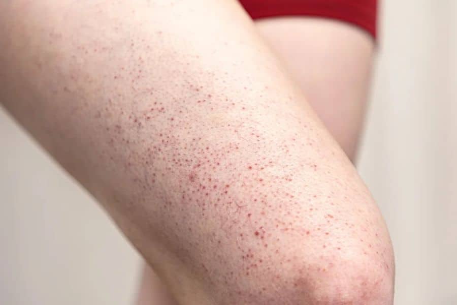Close up of a bent leg covered with many tiny red spots and dark hair follicles. The skin texture and scattered dots make the irritation clearly visible.