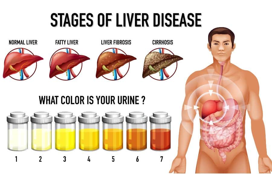 Infographic titled "STAGES OF LIVER DISEASE" showing "NORMAL LIVER" "FATTY LIVER" "LIVER FIBROSIS" and "CIRRHOSIS" above a row of urine samples labeled 1 through 7 under the heading "WHAT COLOR IS YOUR URINE ?". A male body diagram on the right highlights your liver in the center of the abdomen.
