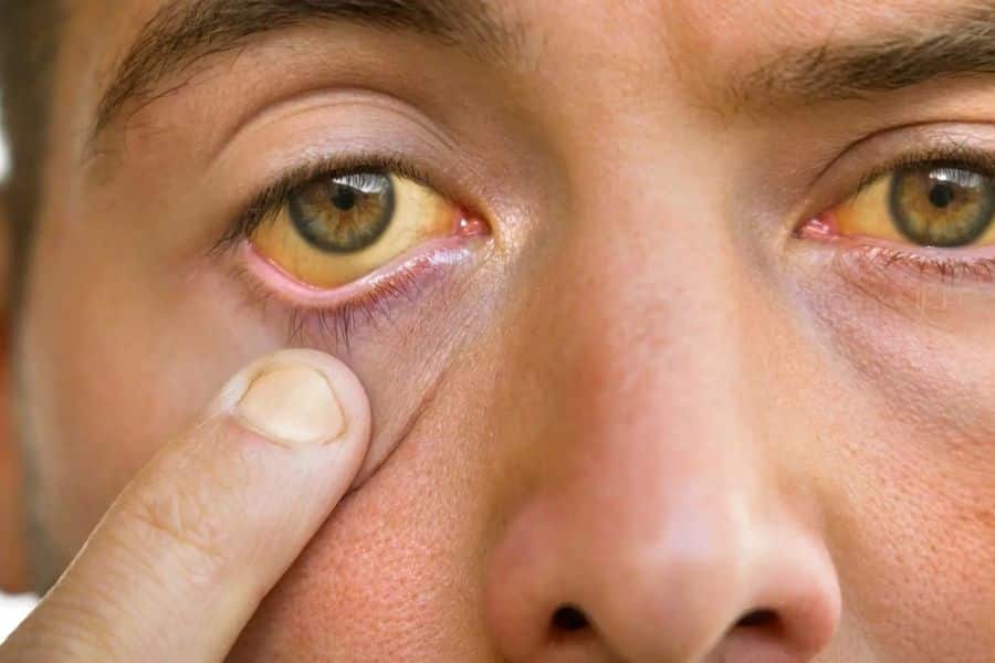 Close up of a person pulling down the lower eyelid to reveal yellowing around the eye. The yellow tint is emphasized as a visible sign often associated with your liver.