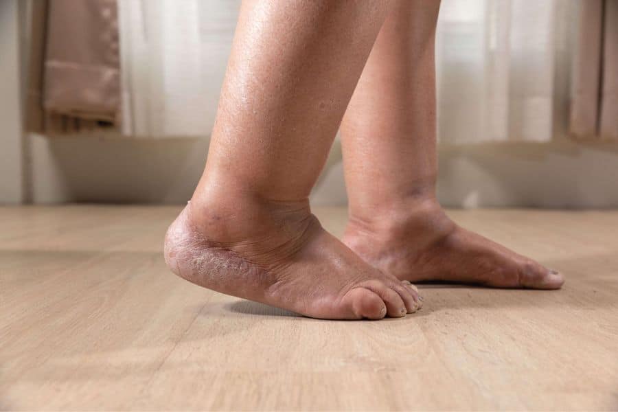 Close up of swollen feet and ankles resting on a wooden floor with heels slightly raised. The puffy skin around the ankles makes fluid buildup easy to notice.