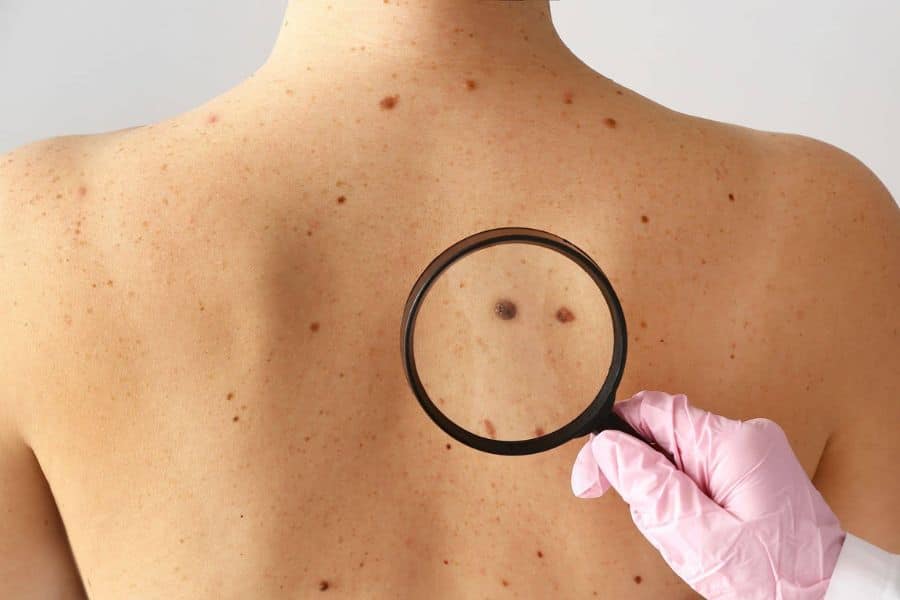 Close view of a person’s bare upper back covered with moles while a gloved hand holds a magnifying glass over two darker spots. This shows a skin check that can help illustrate possible early stages of cancer.