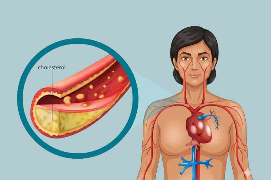 High Cholesterol Causing Problems? Here’s What Your Numbers Actually Mean & What To Do About It