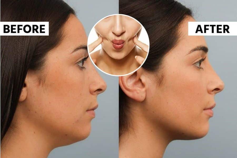 Side by side profile photos labeled “BEFORE” and “AFTER” show a woman with a fuller double chin on the left and a more defined jawline on the right. A circular inset shows fingers pressing into the cheeks while the lips are pursed.