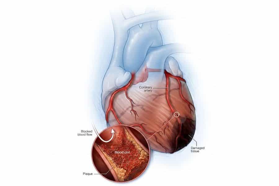Medical illustration showing a heart attack caused by a blocked coronary artery. An enlarged cross section highlights plaque buildup and a blood clot restricting blood flow, with darkened damaged heart tissue visible in the lower portion of the heart.