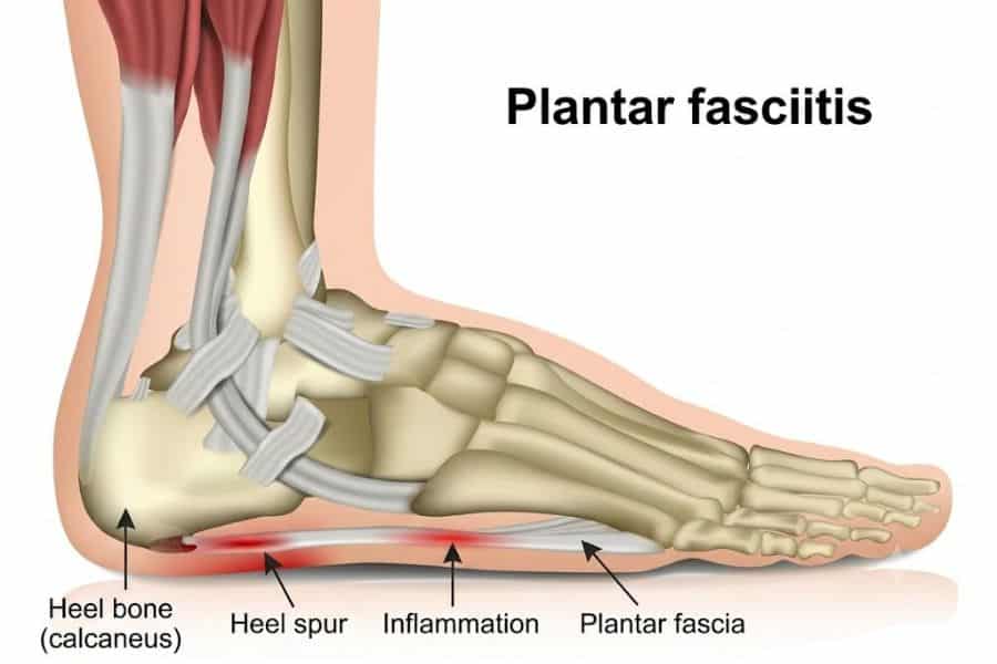 Medical diagram of a foot showing plantar fasciitis and the areas connected to heel pain. Text reads “Plantar fasciitis” “Heel bone calcaneus” “Heel spur” “Inflammation” “Plantar fascia”.